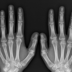 xray of hands