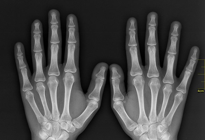 xray of hands